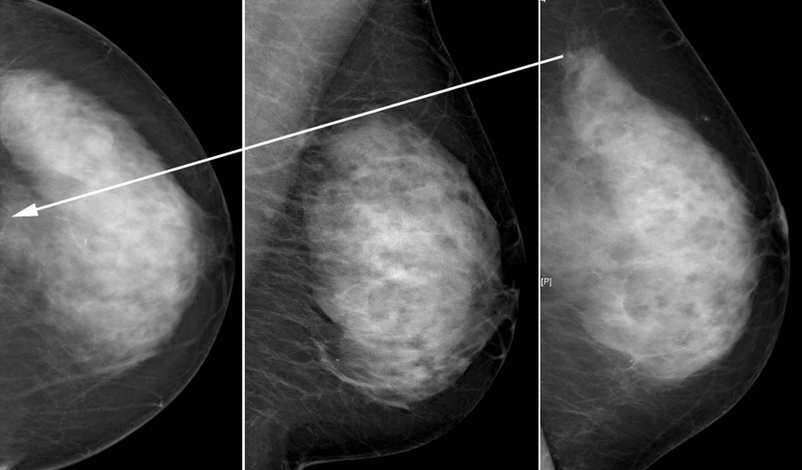 Images pièges en mammographie | Gynécologie Obstétrique Pratique