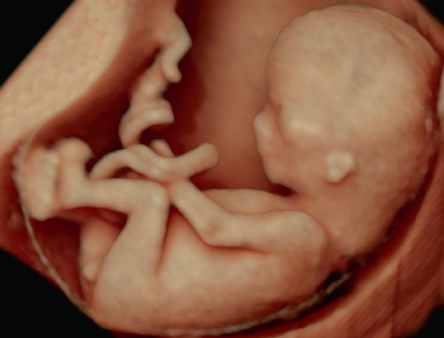 Hypotrophie Fœtale Eviter Les Complications Immediates Et Tardives Gynecologie Obstetrique Pratique Hypotrophie Fœtale Eviter Les Complications Immediates Et Tardives Gynecologie Obstetrique Pratique
