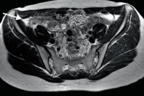 Varice pelvienne et endometriose