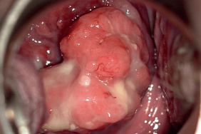 Papillomavirus traitement conisation. Papillomavirus traitement conisation - Basal cell papilloma