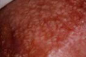 signe papillomavirus chez l homme inflamația papilomului pe față