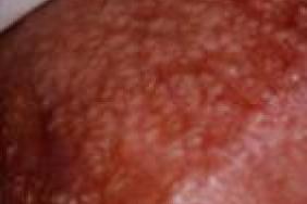 papillomavirus et l homme