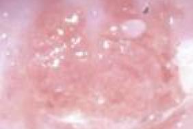 hpv vir ockovani