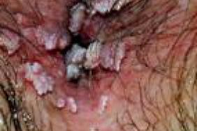 vestibularis papillomatosis fehér