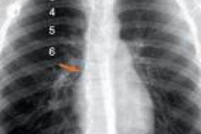 Chambres A Catheters Implantables Pose Entretien Et Gestion Des
