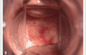 Sécheresse vaginale : estrogène, hydratant, lubrifiant ou laser 