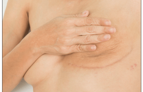 Cancers du sein RE+ Her2- | Des milliers de chimiothérapies inutiles : l’essai RxPONDER clôt la discussion