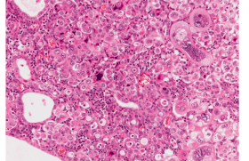 Cancer de l’endomètre – Que retenir des nouvelles recommandations ?