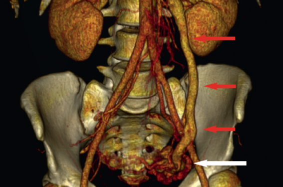 Dilatations veineuses pelviennes