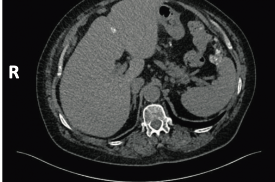 Cancers séreux de bas grade : implications chirurgicales