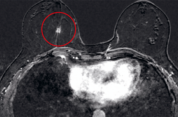 Cytostéatonécrose ou lésion évolutive ?