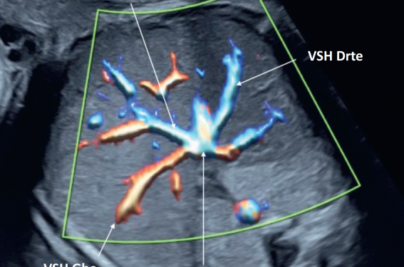 La vascularisation abdominale fœtale et ses anomalies