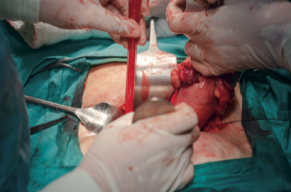 La transplantation utérine ou l’histoire d’une révolution médicale au xxIe siècle